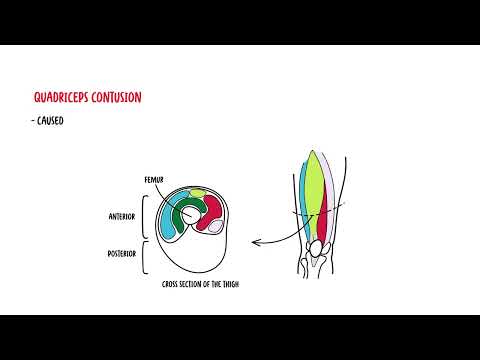 Quadriceps Muscle - quadriceps mujscle injury, strain, quadriceps contusion