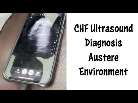 Heart Failure Diagnosed with Ultrasound in a Low Resource Environment