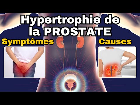 SYMPTÔMES les plus fréquents de l'HYPERTROPHIE BENIGNE DE LA PROSTATE (HBP)