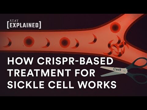 New CRISPR-based sickle cell treatment, explained