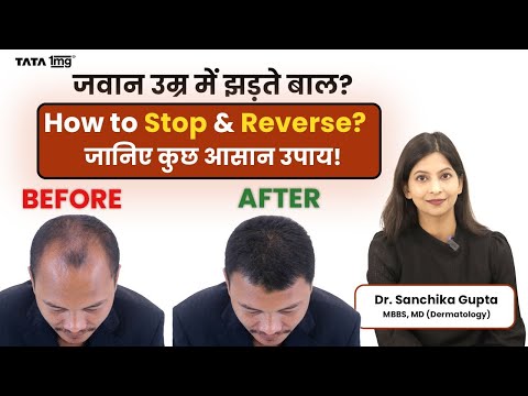 Balding at a Young Age? How to Stop & Reverse It for Good