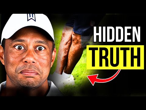 Why Tiger Woods Kept His Horrific Leg Injury a Secret… (Until Now!)