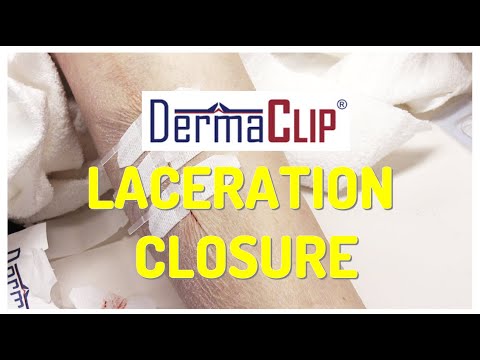 DermaClip Wound Closure Demonstration