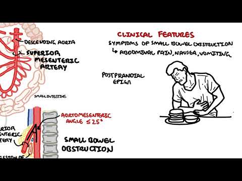 Superior mesenteric artery syndrome (SMA Syndrome) and Nutcracker Syndrome