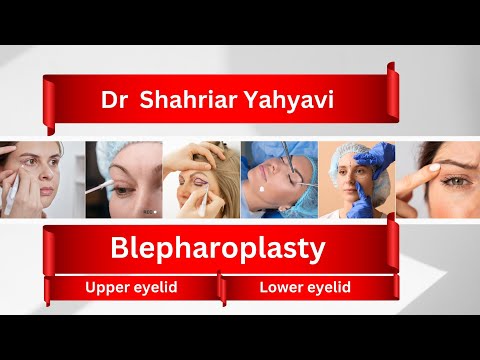 blepharoplasty Upper and lower eyelids by Dr shahriar yahyavi