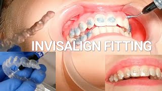 Invisalign Braces Fitting Appointment - Orthodontist Explains Each Step! (Including Attachments)