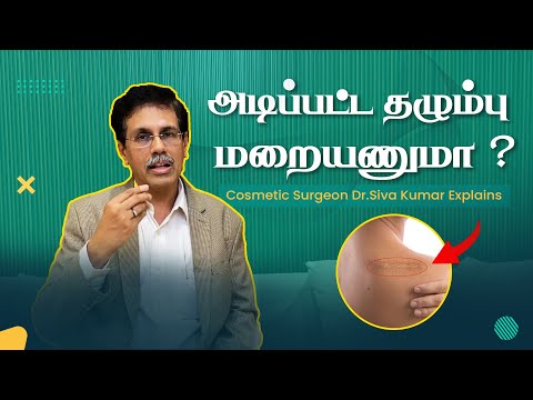 அடிப்பட்ட தழும்பு மறையணுமா (Scars) Dr.Siva Kumarv Explains | Mykare Health