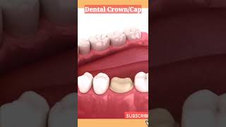 Dental Crown 👑 or Cap 🧢 Procedure #dentistry #dentalcare #animation