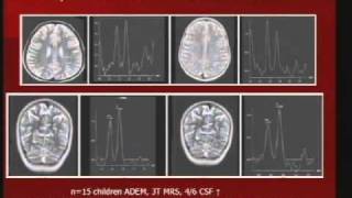 Pediatric ADEM and Transverse Myelitis