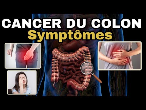 SYMPTÔMES les plus fréquents du CANCER DU COLON (cancer colorectal)