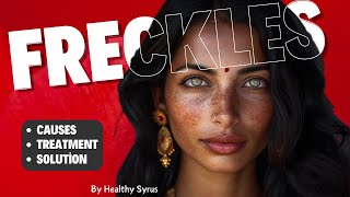 FRECKLES: Causes, Treatment & Natural Solution.