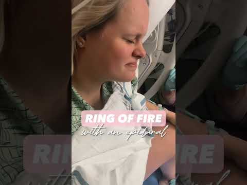 Ring of fire with an epidural ￼