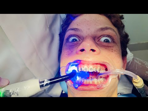 American kids get braces in Brazil - Extreme do's and don'ts