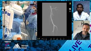 Transradial Genicular Artery Embolization (GAE) for Knee Osteoarthritis (OA)