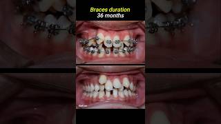 Braces for crowded teeth #braces #orthodontist #dentistry #dentist