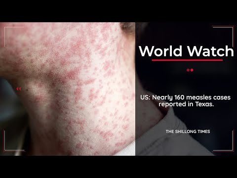 US Nearly 160 measles cases reported in Texas