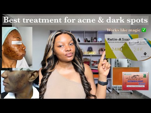 HOW TO GET RID OF STUBBORN ACNE/ PIMPLES AND DARK SPOTS✅ | healthy glowy and youthful skin