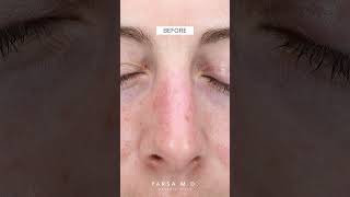 IPL Treatment for Sun Spots and Freckles | Parsa MD | Beverly Hills