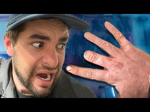 Finger chopped off (camera gear accident)