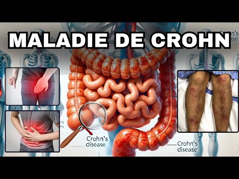 SYMPTÔMES les plus fréquents de la MALADIE DE CROHN