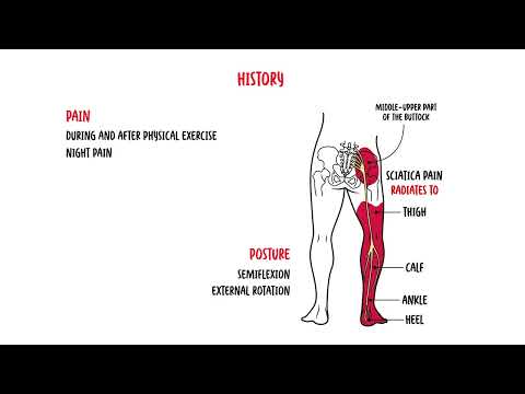 Piriformis Syndrome (buttock pain, siatica)