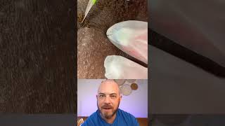 Derm reacts to INSANE ingrown hair extraction! #dermreacts #doctorreacts #ingrownhair