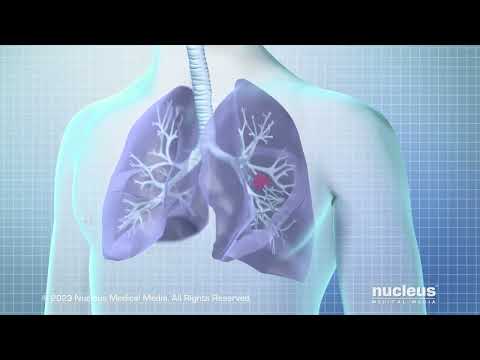 Screening for Lung Cancer