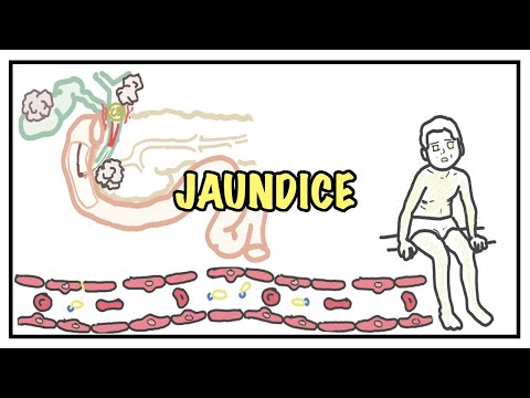 Approach to Jaundice - types and causes of hyperbilirubinemia, investigations