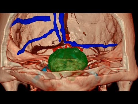 Making brain surgery safer with advanced technology