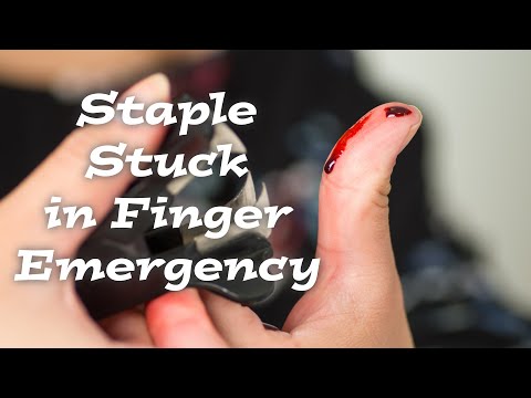 Teenage Girl Accidentally Staples Her Finger