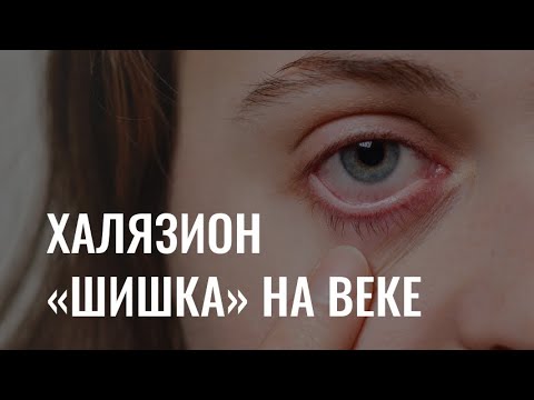 «Шишка» на веке: как лечить халязион?