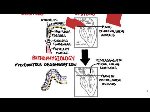 Mitral Valve Prolapse