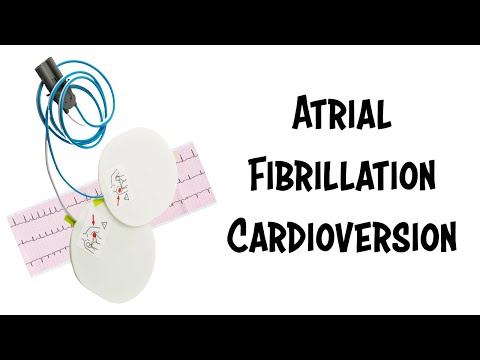 Dr. Bruce Janiak's Cardioversion from Atrial Fibrillation