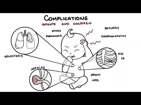 What is Pertussis and whooping cough? - Bordetella pertussis symptoms, pathophysiology and treatment