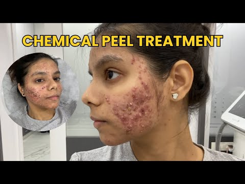 My Chemical Peel Experience | Results? Cost? Is it worth it?