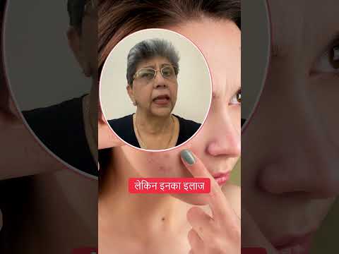 Treatment of White Spots on Face (Milia)