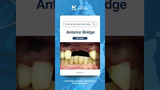 [K Family Dentistry] Anterior Bridge tooth #6 ~ #11 case study reels. #dentalcare #dentalprocedure