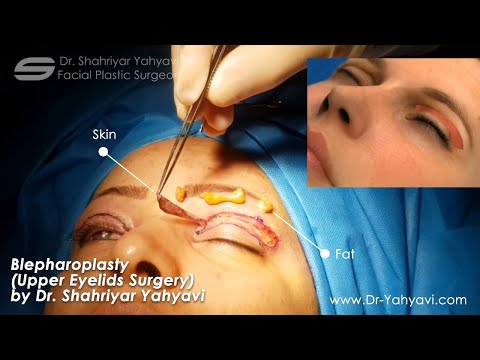 Blepharoplasty (Upper Eyelids Surgery) By Dr. Yahyavi in Iran