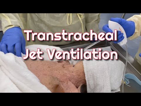 Transtracheal Jet Ventilation in a Cadaver Model