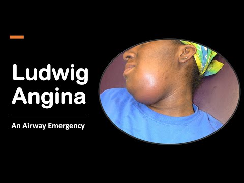 Ludwig Angina: An Airway Emergency