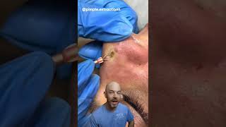 You won’t believe this GIANT pimple extraction! 👃(credit:pimple.extractionn on TT)#satisfying #viral