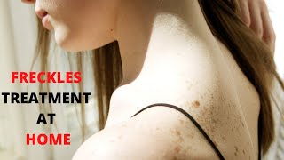 Freckles Treatment at Home - The Expert Way to Treat Freckles