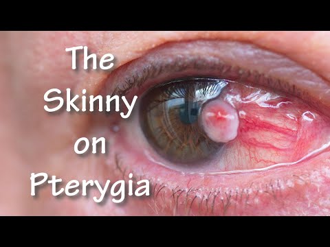 The Skinny on Pterygia