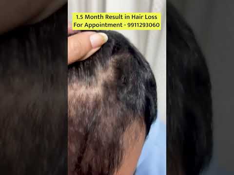 Stunning Hair Transformation in Just 1.5 Months!