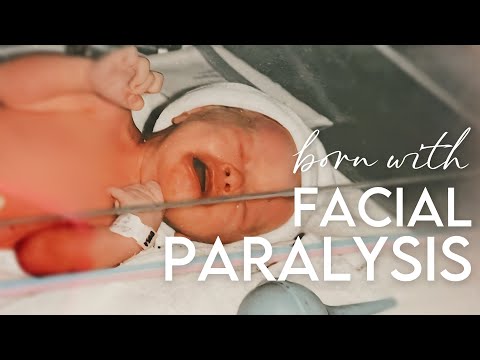 born with facial paralysis