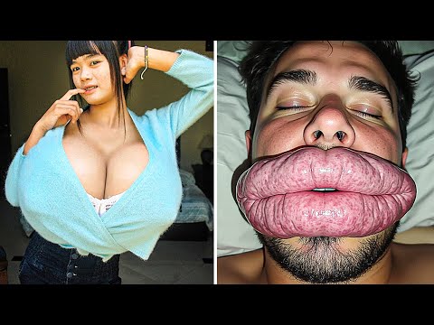 20 Most Unusual Plastic Surgery Disasters