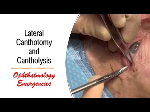 Lateral Canthotomy and Cantholysis