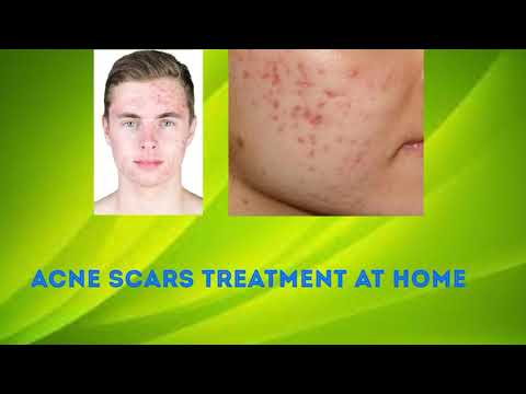 Acne Scars Treatment at home