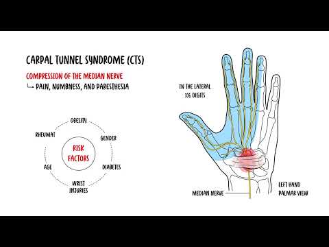 Understanding Carpal Tunnel Syndrome and Carpal Tunnel Anatomy