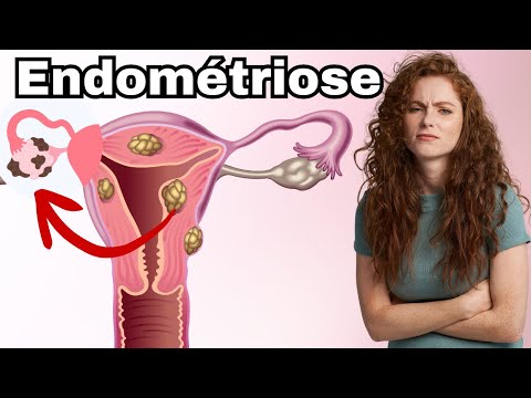 Voici TOUT ce qu'il faut savoir sur l’ENDOMETRIOSE : Cause, traitements et symptômes